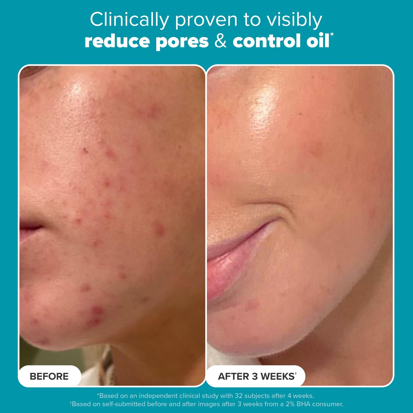 Paula's Choice SKIN PERFECTING 2% BHA Liquid Salicylic Acid Exfoliant-Facial Exfoliant for Blackheads, Enlarged Pores, Wrinkles & Fine Lines